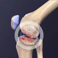Inflamação nas Articulações